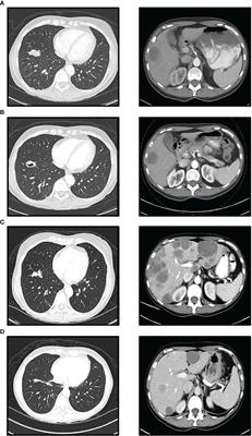 Deep response to a combination of mTOR inhibitor temsirolimus and dual immunotherapy of nivolumab/ipilimumab in poorly differentiated thyroid carcinoma with PTEN mutation: a case report and literature review